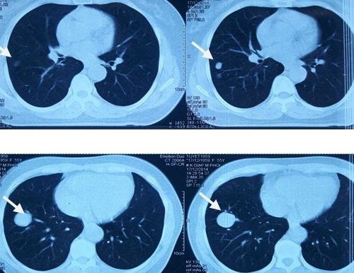 Is a lung scan harmful?