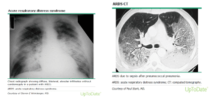 Clinical – Diagnostic criteria – Approach to diagnosis of ARDS