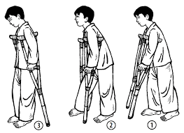 
Thời gian đầu, người bệnh cần sử dụng nạng để thuận tiện đi lại
