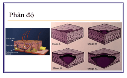 
Phân độ loét do tỳ đè qua hình ảnh
