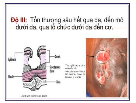 
Độ 3: Tổn thương sâu hết qua da, đến mô dưới da, qua tổ chức dưới da đến cơ
