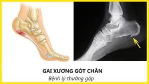 Hình ảnh gai xương gót chân trên X quang