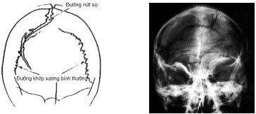 
Hình ảnh nứt sọ chụp X-Quang
