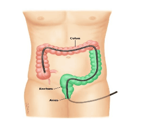 
Nội soi đại tràng sigma để tìm nguyên nhân gây ra phân có máu
