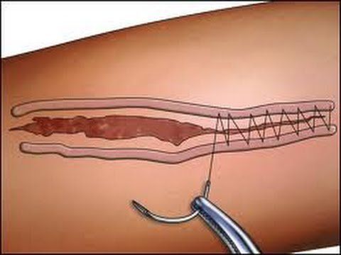 
Khâu vết thương là kỹ thuật giúp quá trình liền da nhanh và ngăn sự nhiễm trùng
