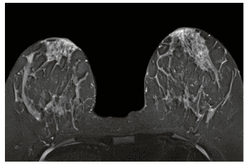 Chụp cộng hưởng từ (MRI) tuyến vú