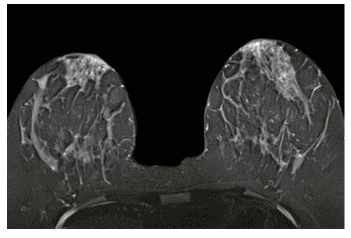 Magnetic resonance imaging (MRI) of the breast