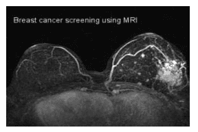 
Hình ảnh khối u vú trái trên MRI
