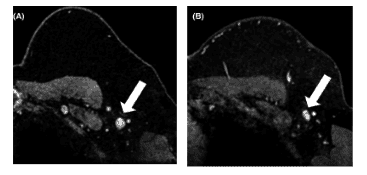 
Hình ảnh ung thư di căn hạch nách trên MRI
