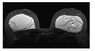 
Hình ảnh túi ngực bình thường và túi ngực bị rách trên MRI
