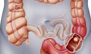 Diagnosis of intestinal obstruction should be X-ray or ultrasound