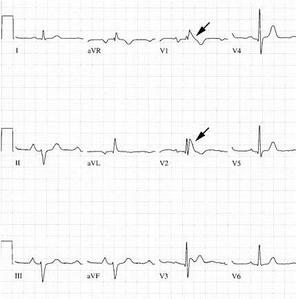 Hội chứng Brugada – 1 trong các nguyên nhân gây đột tử