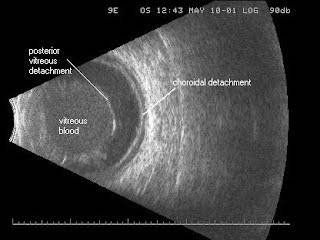 
A-scan thường được áp dụng để đo kích thước mắt
