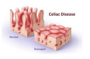 
Hàng rào biểu mô niêm mạc bị phá vỡ gây ra các triệu chứng trong bệnh Celiac
