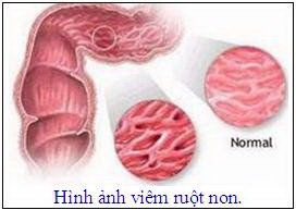 
Bệnh celiac nếu để lâu ngày không được điều trị có thể dẫn tới viêm loét ruột non
