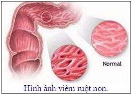 
Bệnh celiac nếu để lâu ngày không được điều trị có thể dẫn tới viêm loét ruột non
