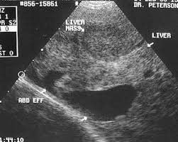 Liver cancer ultrasound images