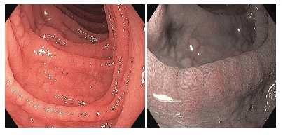 
Hình ảnh bên trái thể hiện dạng chi tiết của các nếp gấp niêm mạc bao gồm các vết nứt ở bề mặt niêm mạc có thể nhìn thấy được. Hình ảnh bên phải được tạo ra bằng NBI và lấy nét gần cho thấy mất nhung mao.
