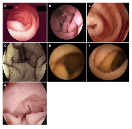 Gastrointestinal endoscopy image of Celiac disease