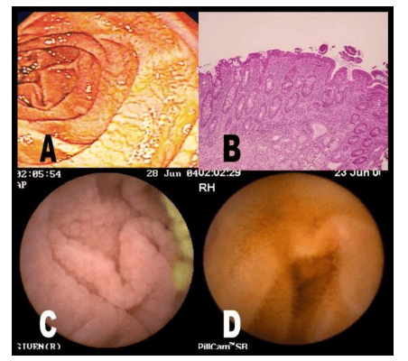 
Hình ảnh một bệnh nhân khác được chẩn đoán bệnh Celiac có teo niêm mạc ruột và niêm mạc ruột có khía.
