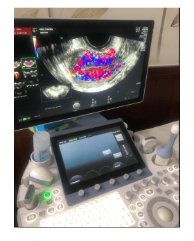 
Máy Volusion E6 đời mới nhất tại Trung tâm IVF Vinmec dùng để siêu âm doppler NMTC, khảo sát buồng tử cung, tìm nguyên nhân chuyển phôi thất bại.
