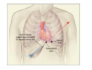 
Chọc dò dịch màng ngoài tim theo đường dưới mũi ức đường marfan
