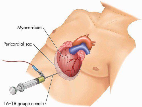 The technique of pericardial aspiration under ultrasound guidance