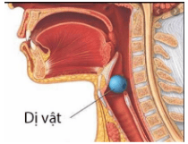 
Dị vật lớn trong đường thở thường gây tắc nghẽn đường thở
