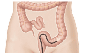 Prevention of late complications with coating agents in endoscopic resection of colorectal lesions - Current status in gastrointestinal endoscopy