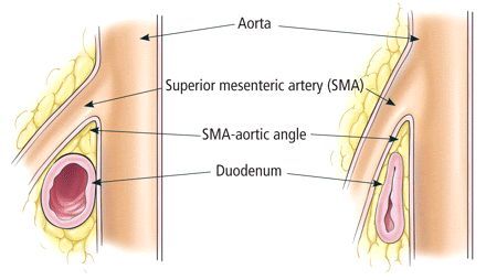 Hội chứng động mạch mạc treo tràng trên