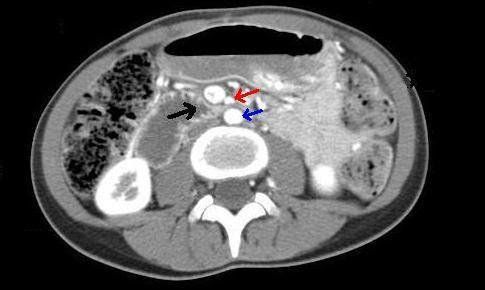 
CT bụng và vùng chậu cho thấy: tá tràng bị chèn ép (mũi tên đen) giữa động mạch mạc treo tràng trên (mũi tên màu đỏ) và động mạch chủ bụng (mũi tên màu xanh).
