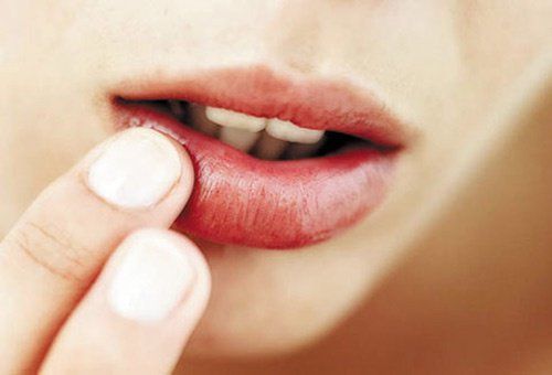 
Nhiễm virus Herpes có biểu hiện đa dạng từ phồng rộp môi đến viêm niêm mạc
