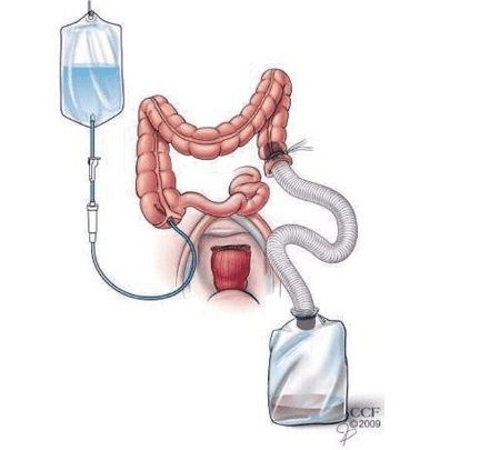 
Hình 4. Kỹ thuật rửa ruột trong mổ.
