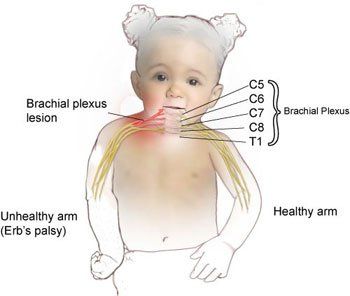 
Bệnh liệt Erb có thể gây liệt cánh tay
