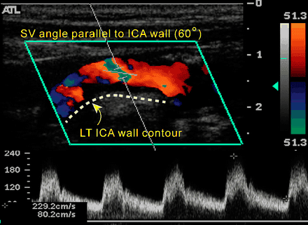 Pitfalls in color Doppler ultrasound of carotid-vertebral arteries