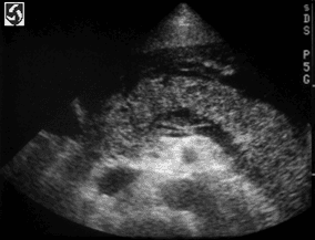 Standard slices in pancreatic ultrasound