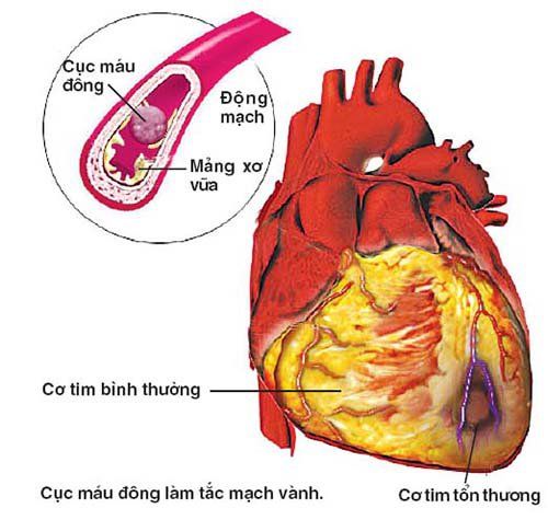 
Cục máu đông xuất hiện chặn nguồn cung cấp máu cho cơ tim, gây ra một cơn đau thắt ngực hay nhồi máu cơ tim
