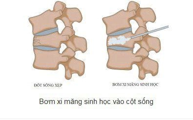 
Bơm xi măng sinh học điều trị lún cột sống
