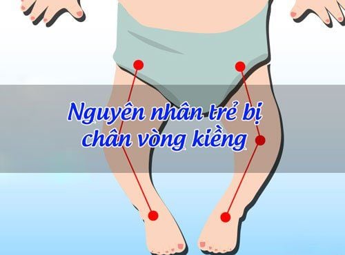 
Nguyên nhân gây chân vòng kiềng ở trẻ
