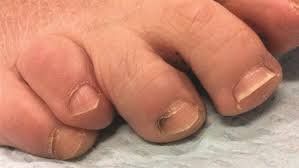 Treatment of nail bed trauma