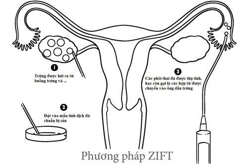 
Phương pháp chuyển hợp tử trong ống dẫn trứng (ZIFT)
