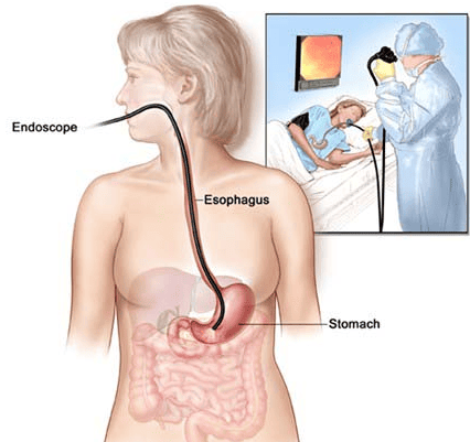 
Nội soi dạ dày vẫn là cách chính để phát hiện ESCC sớm
