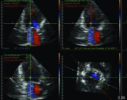 Color Doppler echocardiography in myocardial infarction