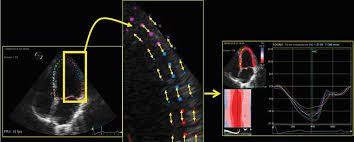 
Hình ảnh siêu âm sức căng cơ tim bằng phương pháp Speckle tracking
