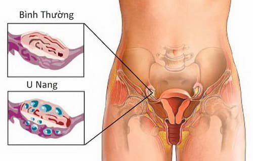 
Trường hợp u nang tử cung nhỏ sẽ được các bác sĩ khuyến nghị điều trị bằng thuốc
