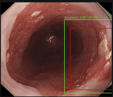
Hình 4: Hình ảnh loạn sản thực quản được đánh giá qua hệ thống nội soi có sử dụng trí tuệ nhân tạo AI
