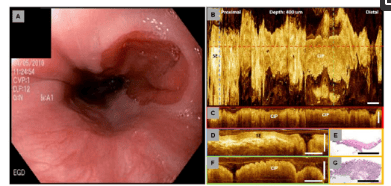 
Hình 8: Hình ảnh chụp cắt lớp quang kết hợp qua nội soi (EOCT) của một tổn thương ở thực quản
