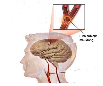 
Cục máu đông ở não có thể là do chất béo tích tụ trong thành mạch máu
