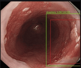 
Hình 5: Hình ảnh loạn sản thực quản được đánh giá qua hệ thống nội soi có sử dụng trí tuệ nhân tạo AI: máy tính sẽ tìm khu trú tổn thương tự động (ô màu đỏ), đánh giá tổn thương đó có bao nhiêu phần trăm là ung thư
