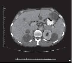 Diagnostic imaging on computed tomography of the spleen